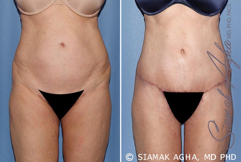 Tummy Tuck