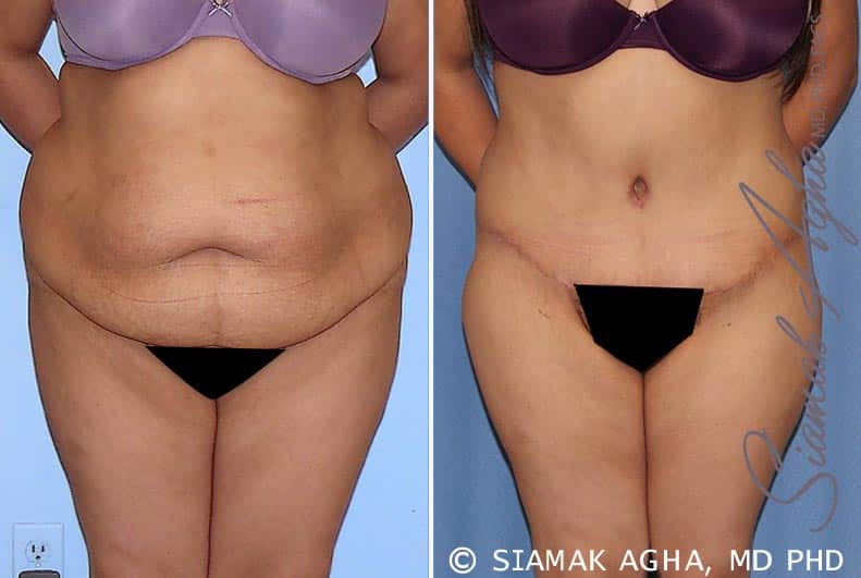 Tummy Tuck