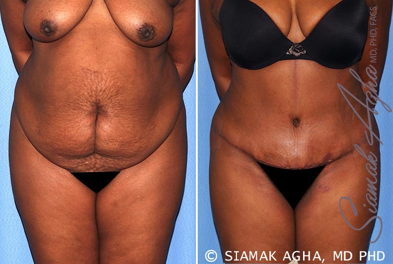 Tummy Tuck