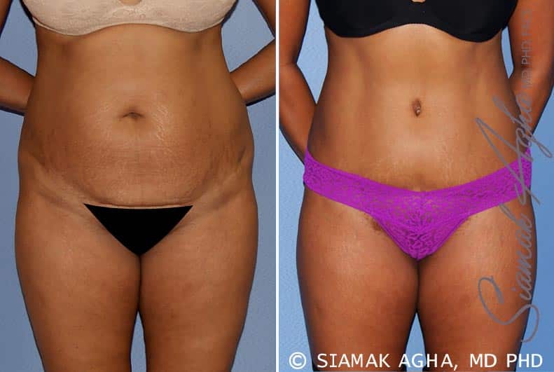 Tummy Tuck