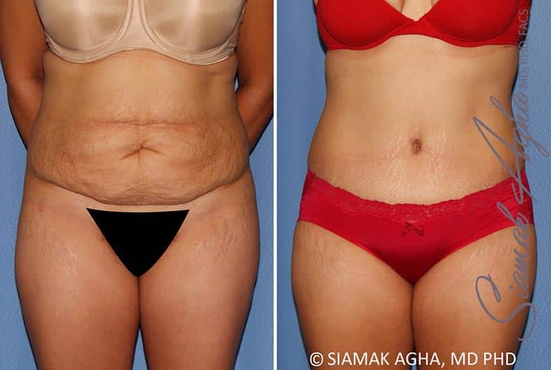 Tummy Tuck