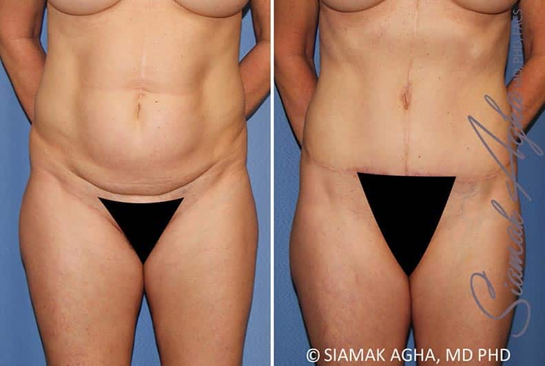 Tummy Tuck