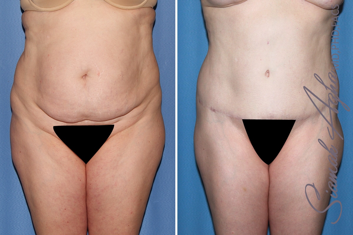 Tummy Tuck