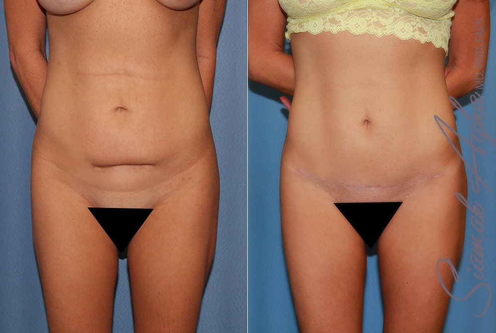 Tummy Tuck