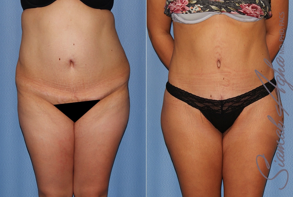 Tummy Tuck