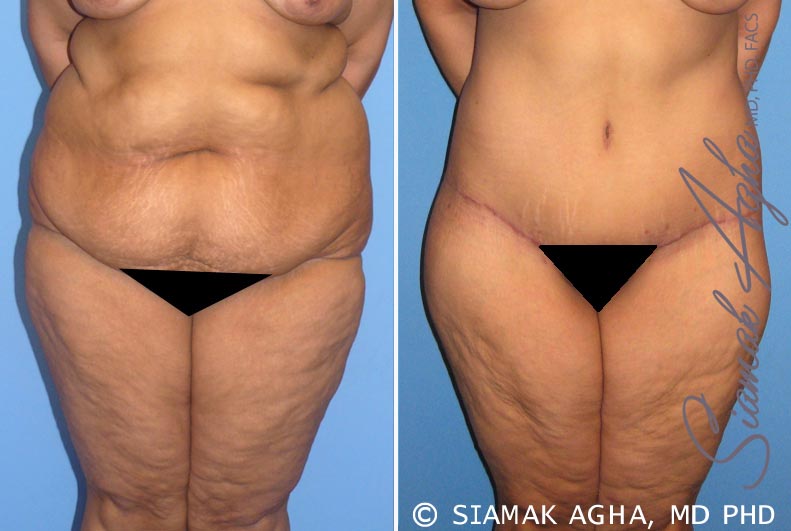 Tummy Tuck