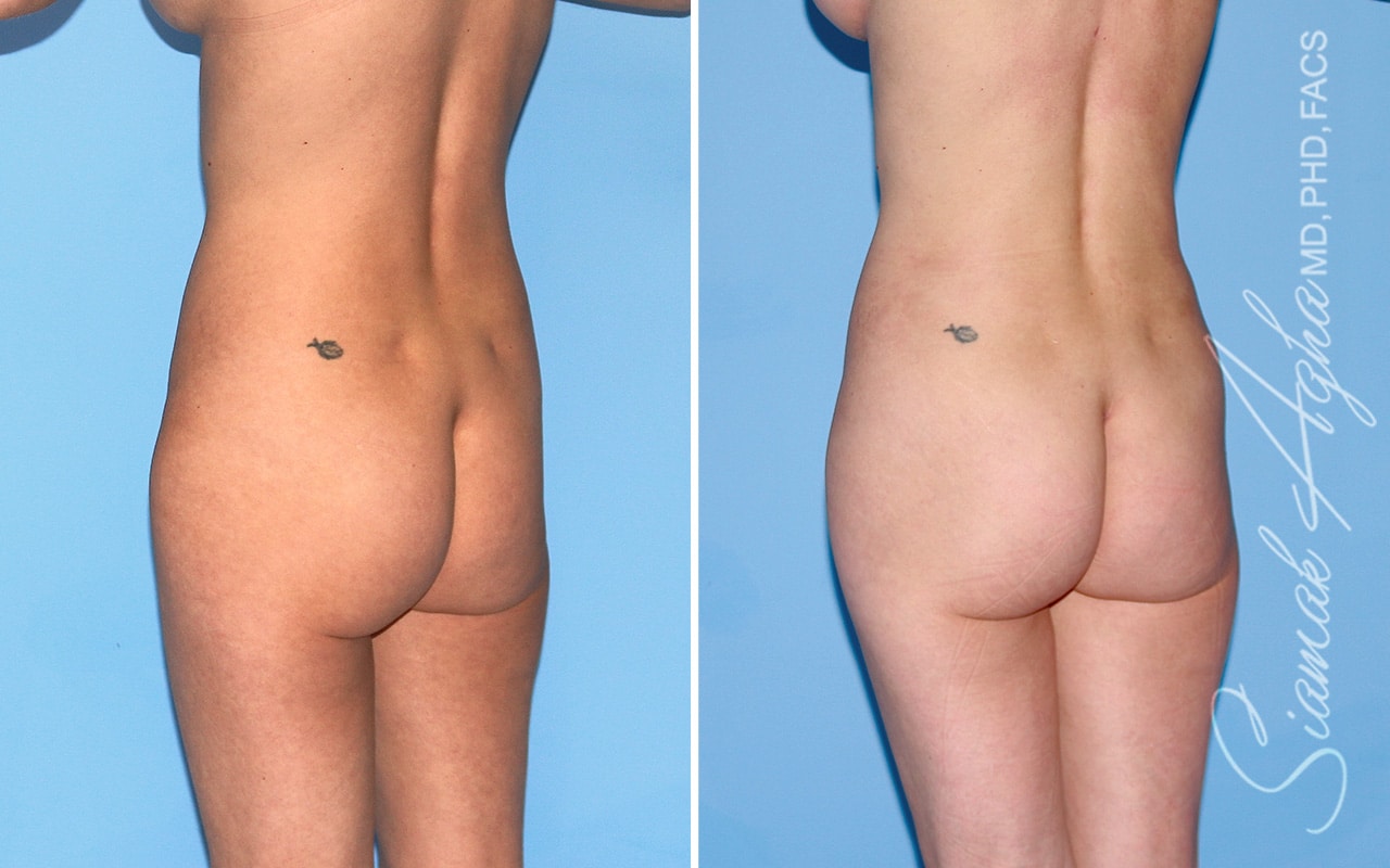 orange county brazilian butt lift patient 69 back left Newport Beach, CA