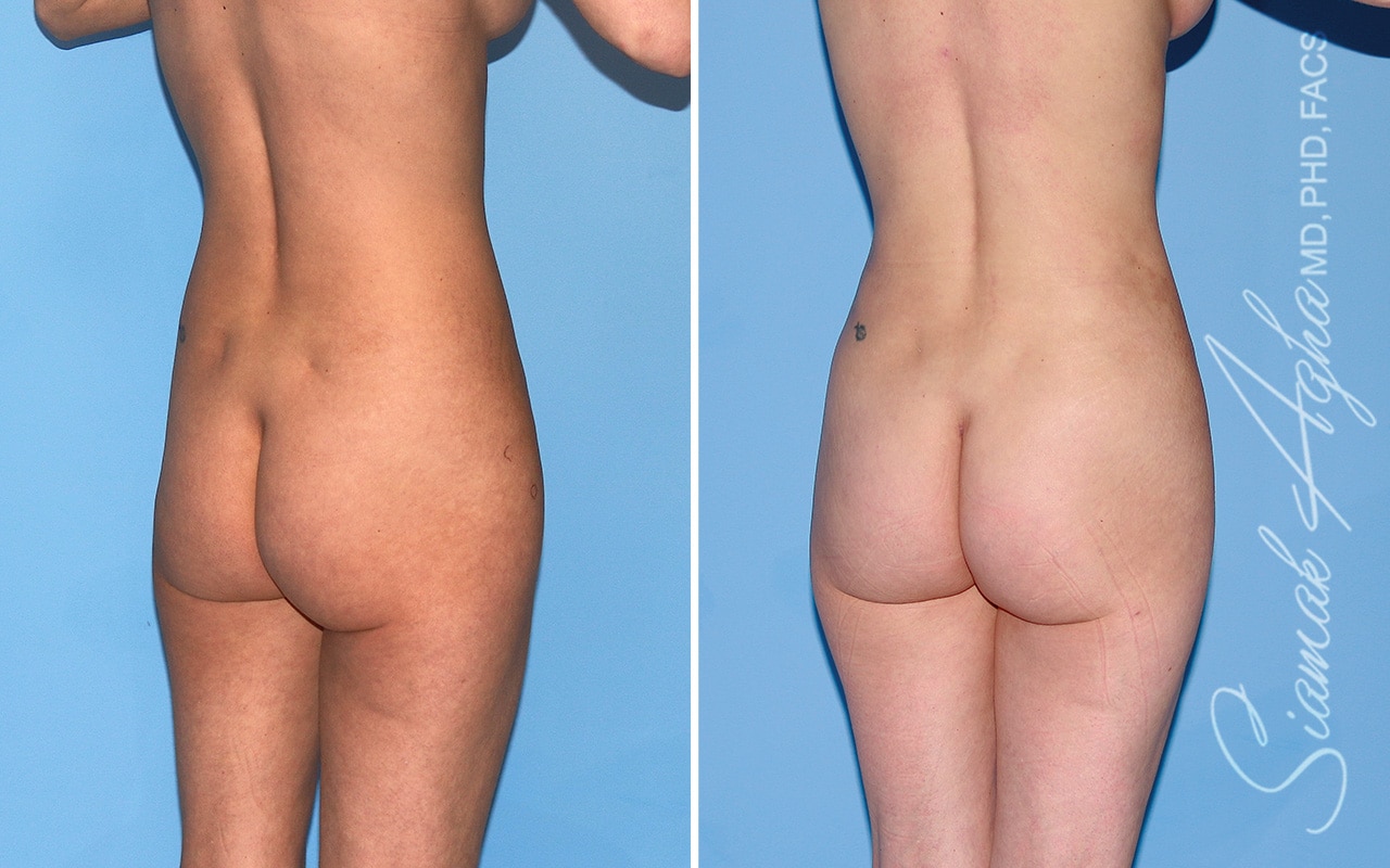 orange county brazilian butt lift patient 69 back right Newport Beach, CA