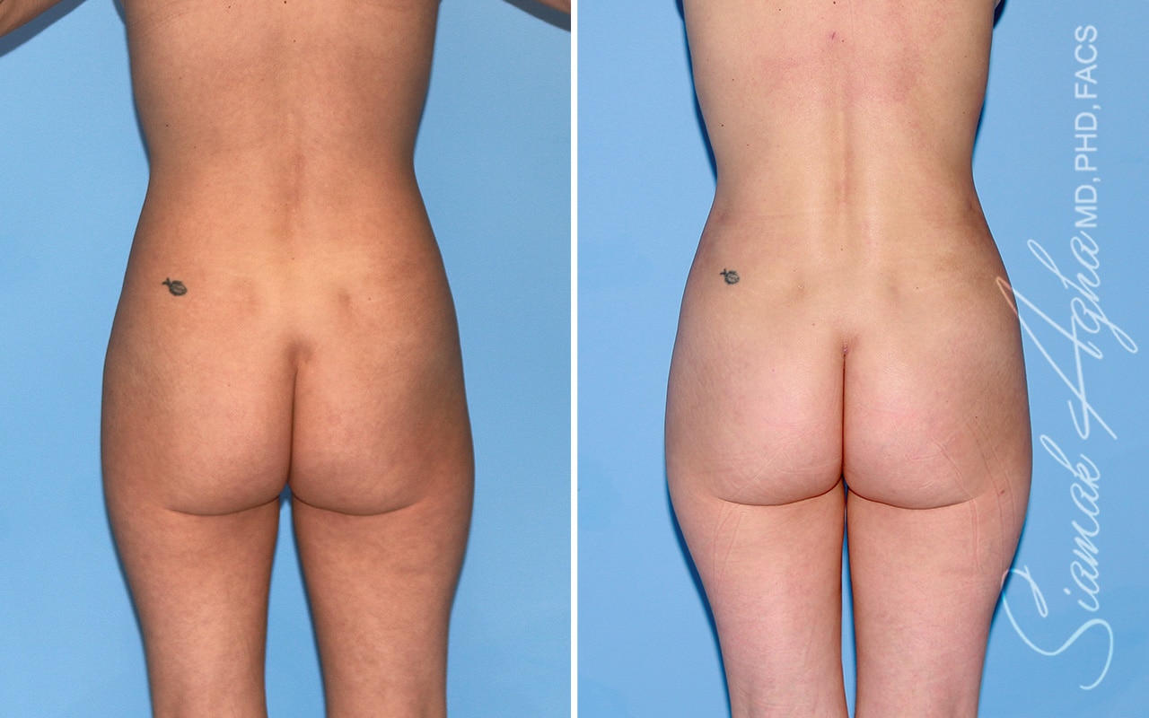 orange county brazilian butt lift patient 69 back Newport Beach, CA