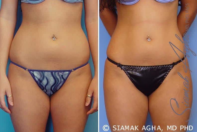 Liposuction