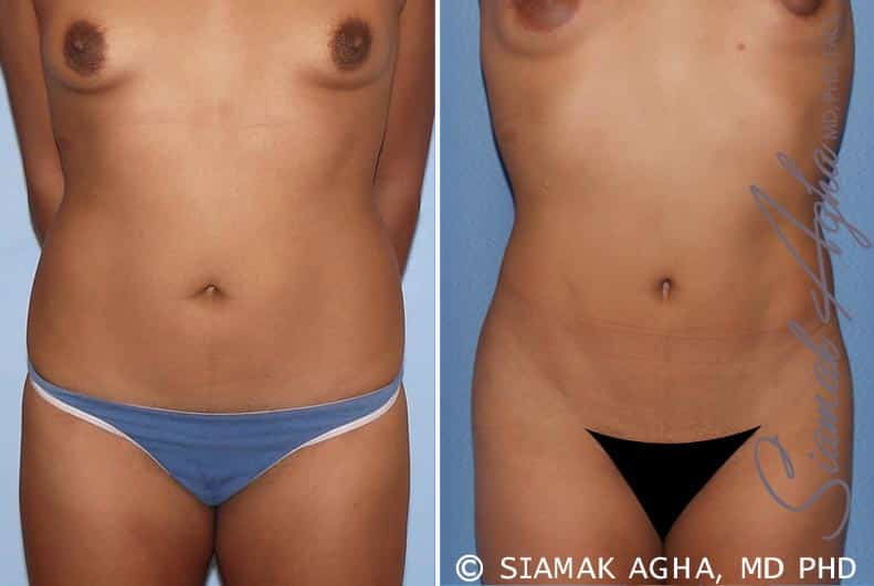 Liposuction