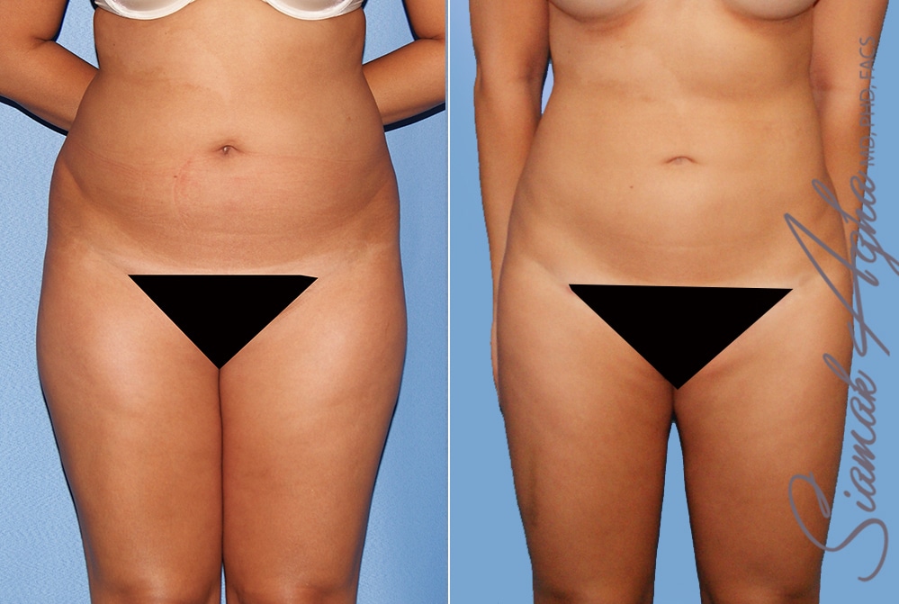 Liposuction