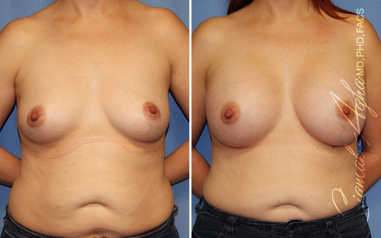 Breast Augmentation