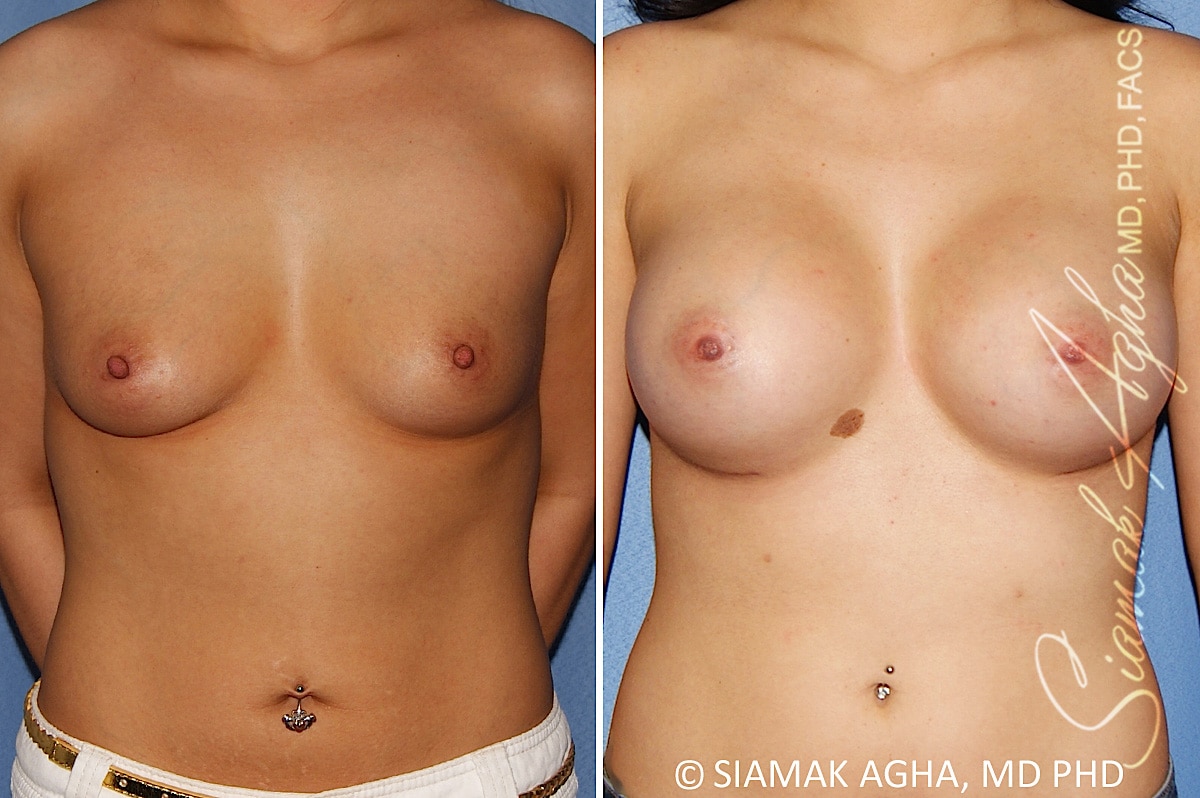 Breast Augmentation