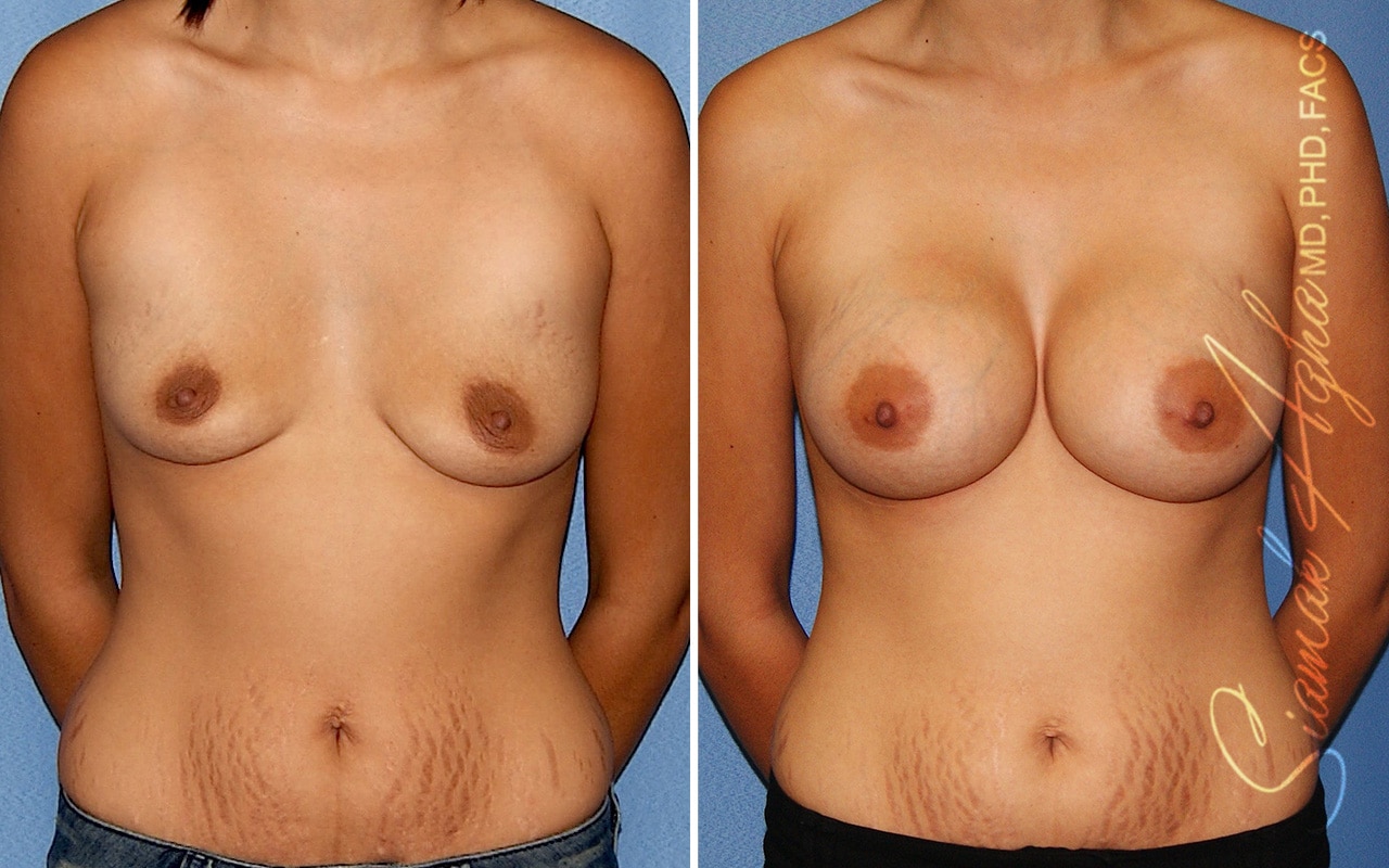 Breast Augmentation