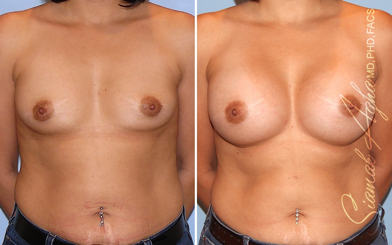 Breast Augmentation