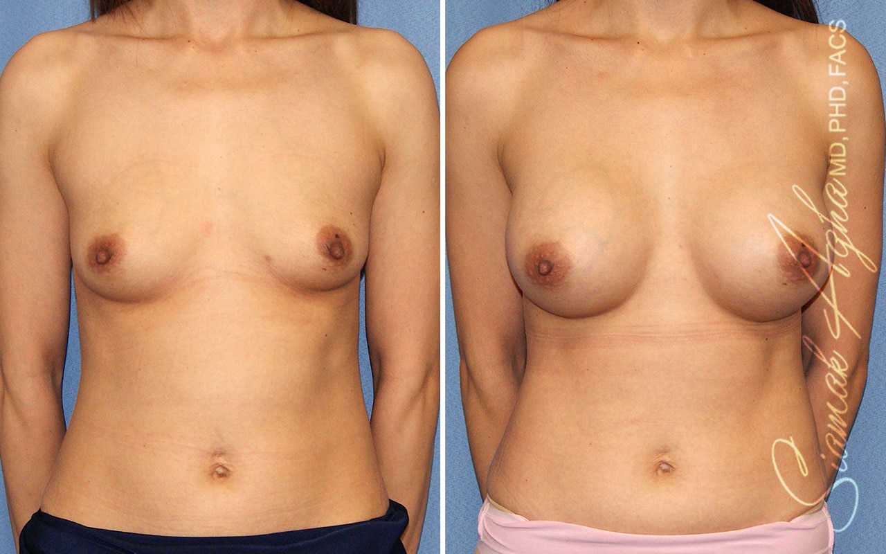 Breast Augmentation