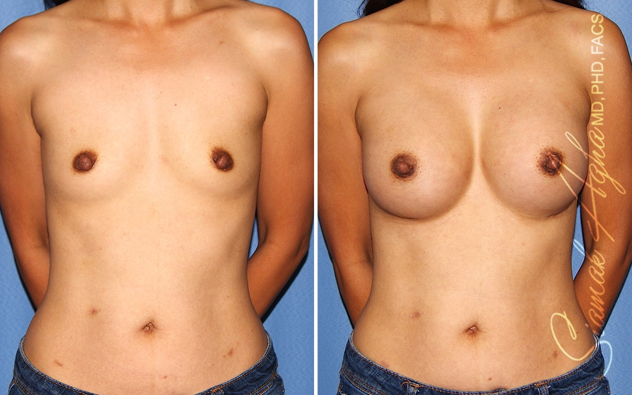 Breast Augmentation