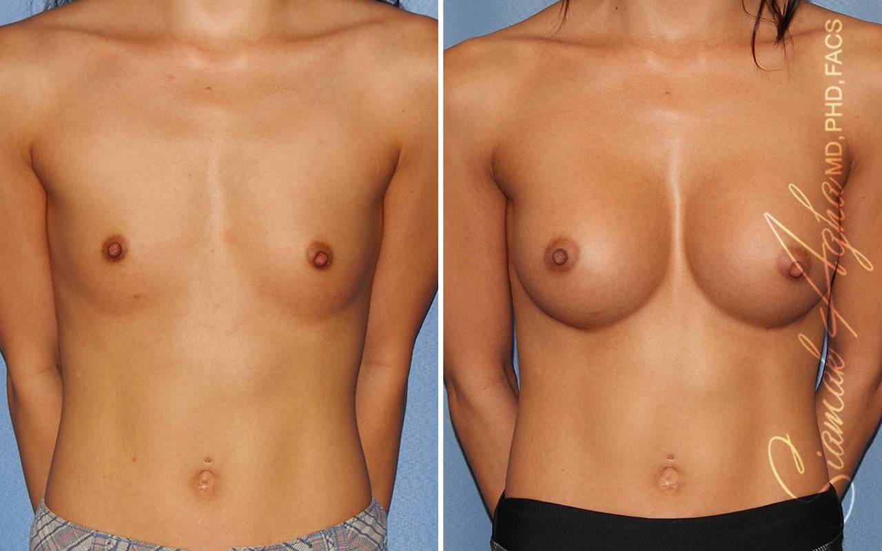 Breast Augmentation