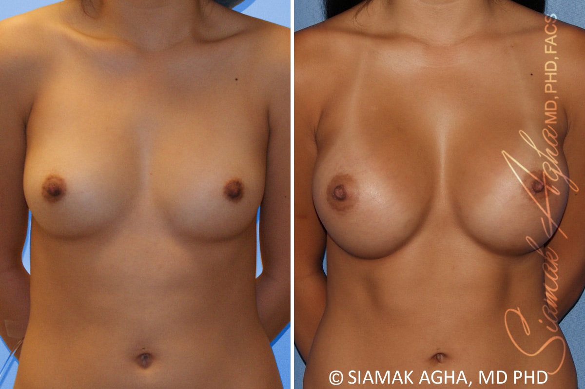 Breast Augmentation