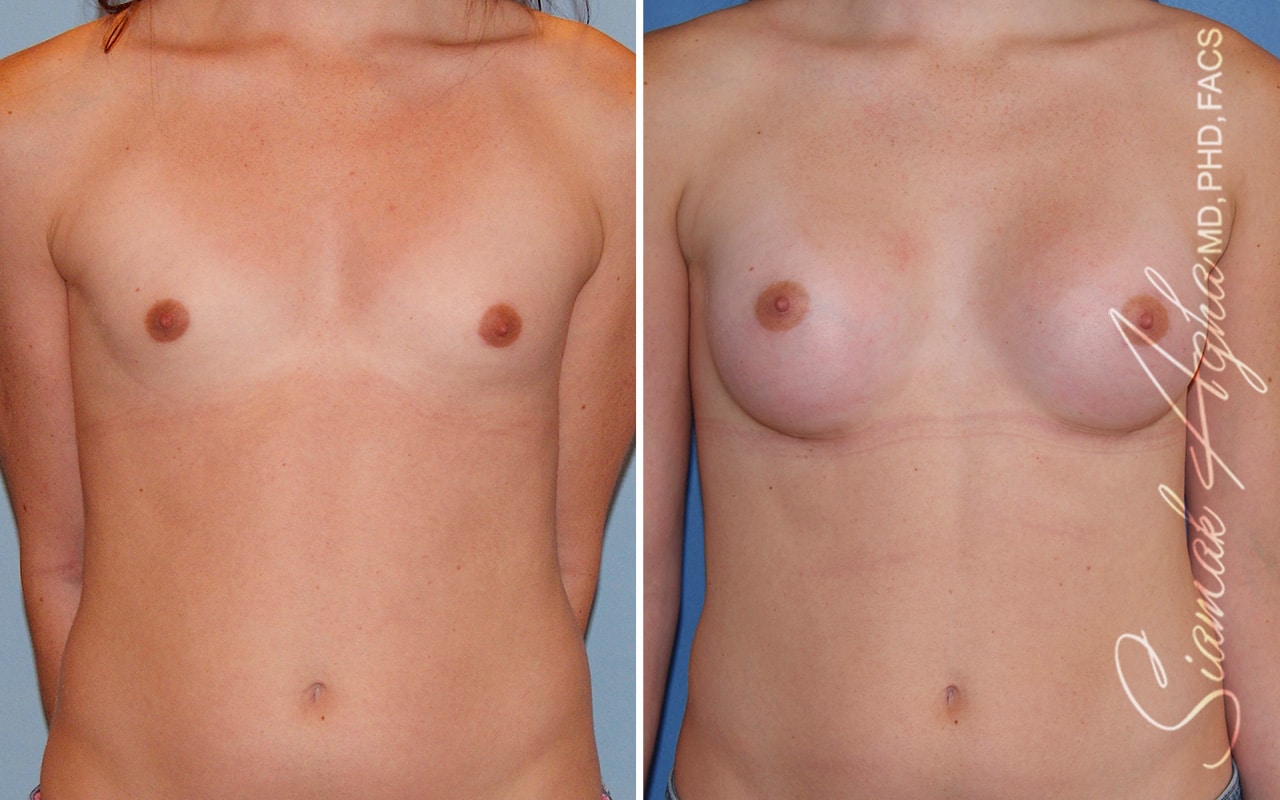 Breast Augmentation