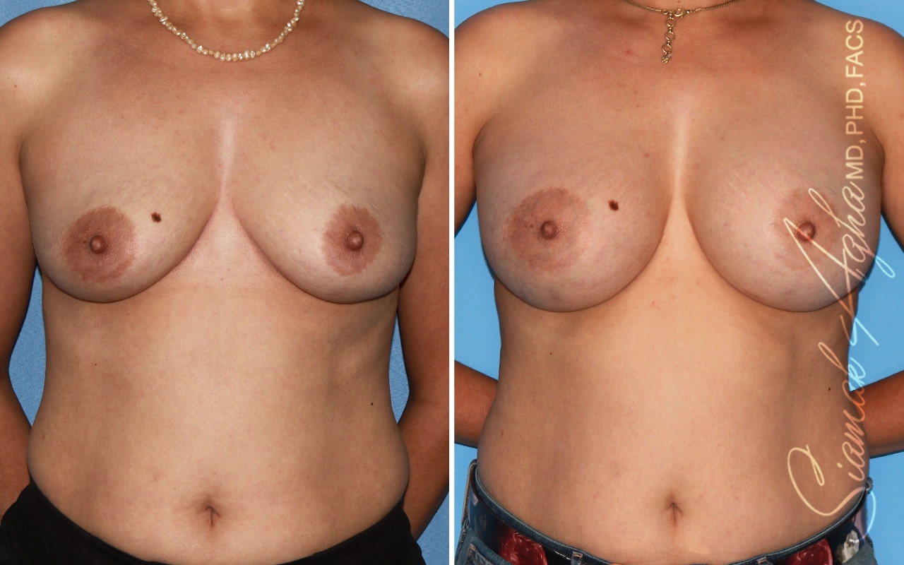 Breast Augmentation