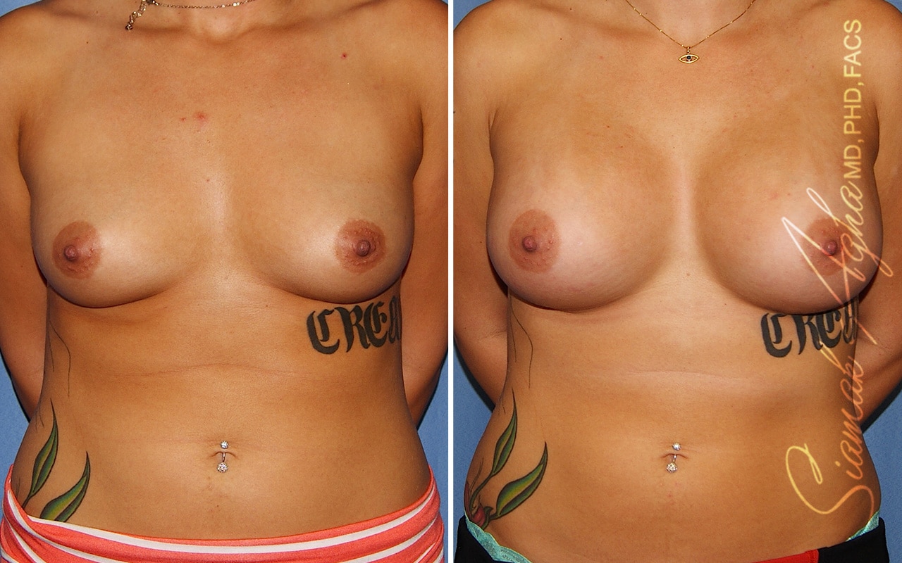 Breast Augmentation