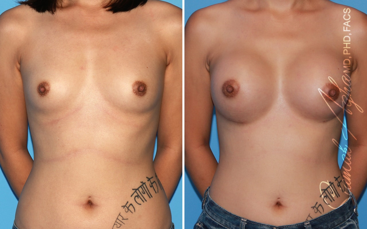 Breast Augmentation