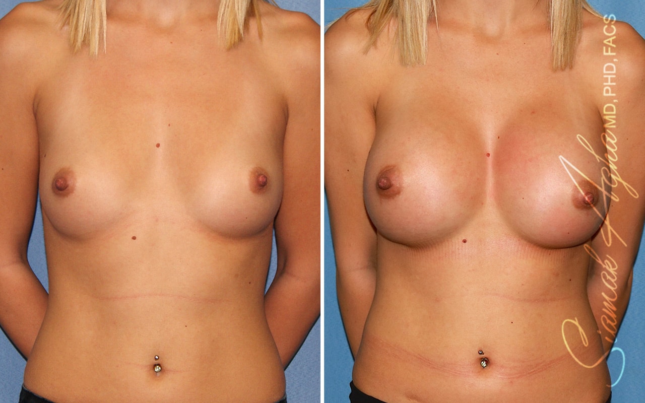 Breast Augmentation