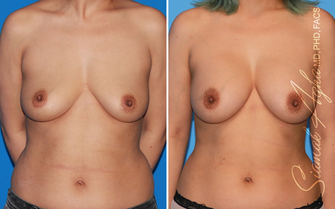 Breast Augmentation