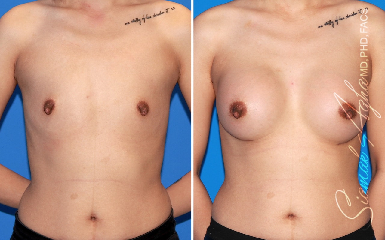 Breast Augmentation