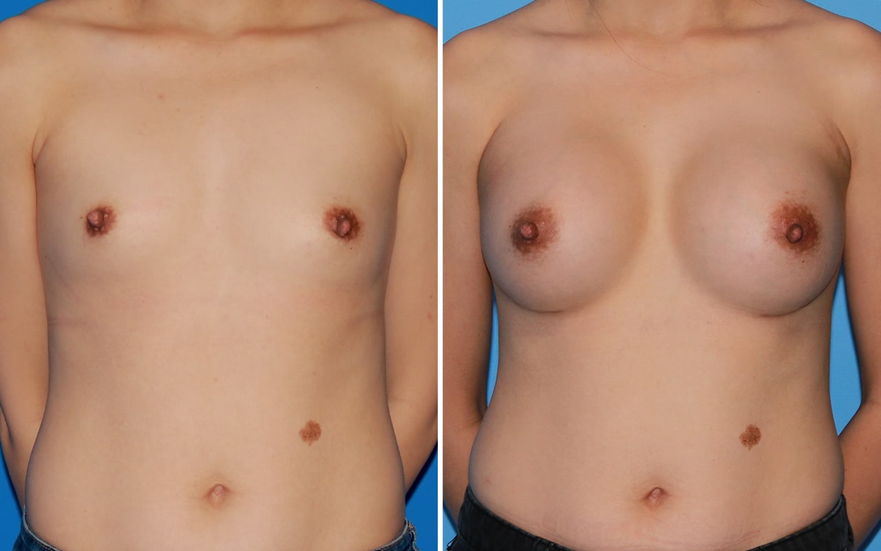 Breast Augmentation