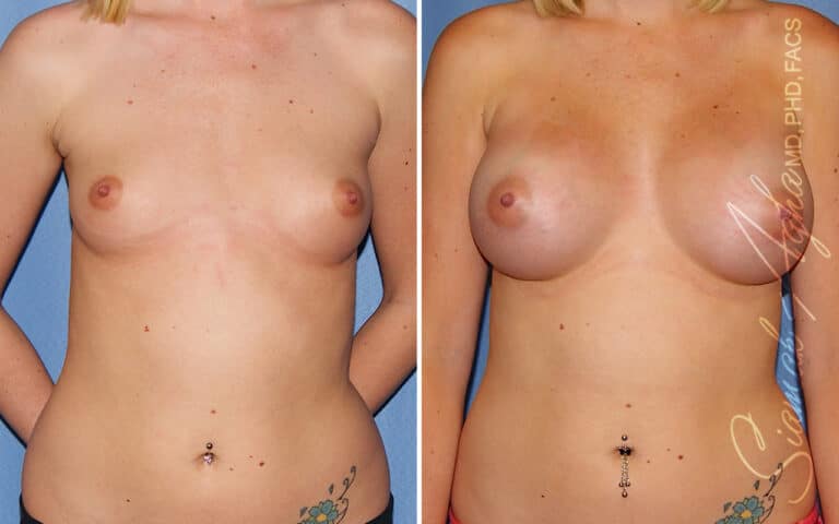 Breast Augmentation Revision