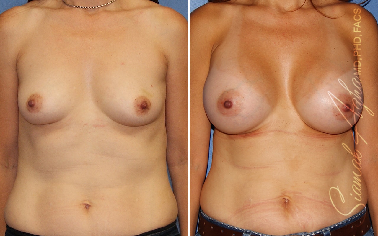 Breast Augmentation