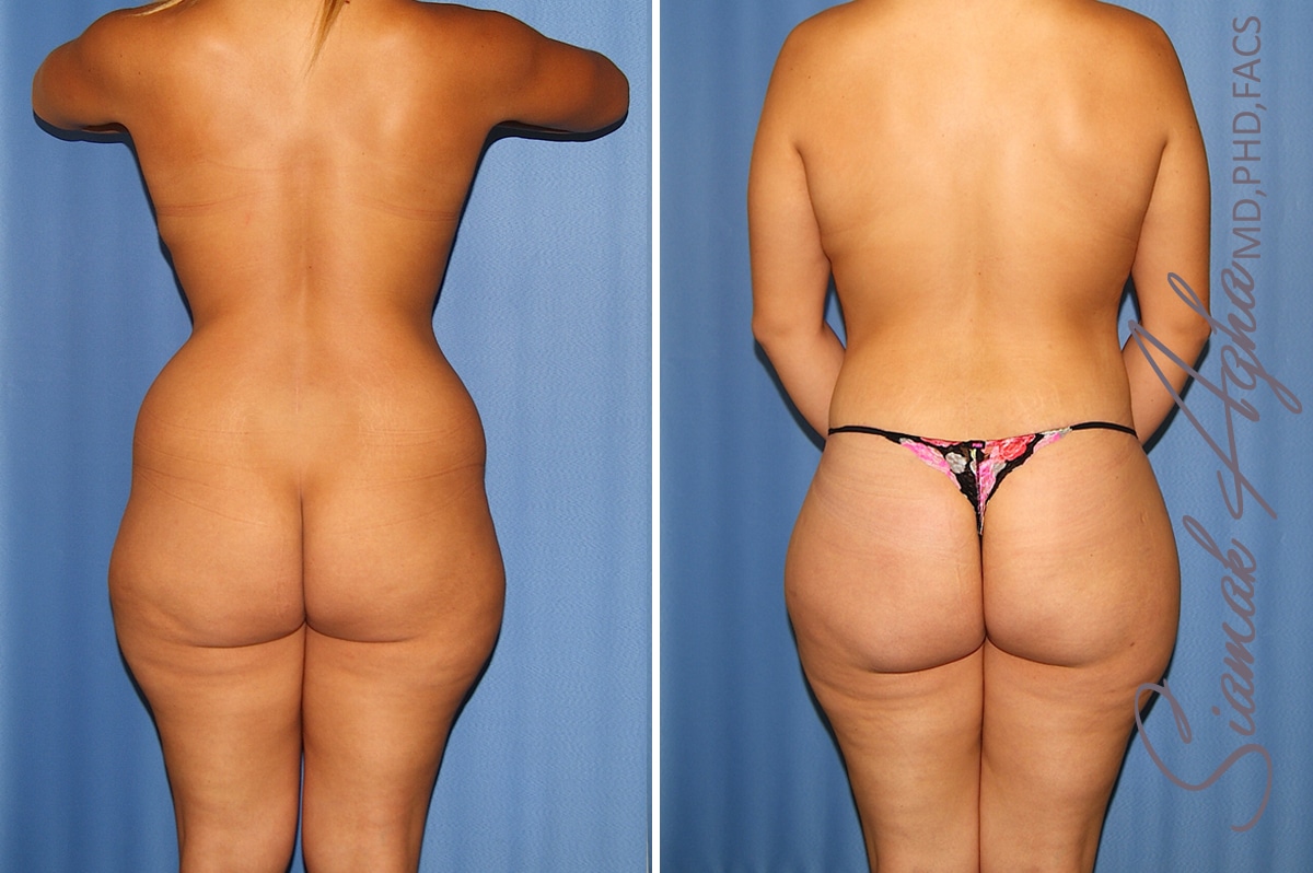 Orange County Total Body Lift Patient 36 Back 1 Newport Beach, CA