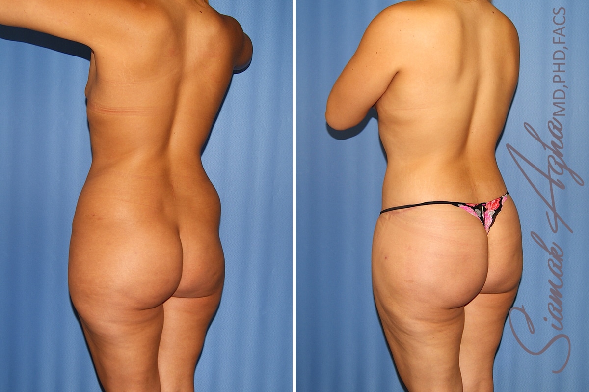 Orange County Total Body Lift Patient 36 Back Left 1 Newport Beach, CA