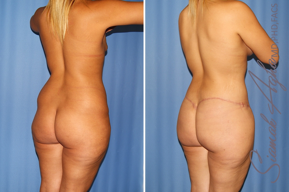 Orange County Total Body Lift Patient 36 Back Right Newport Beach, CA