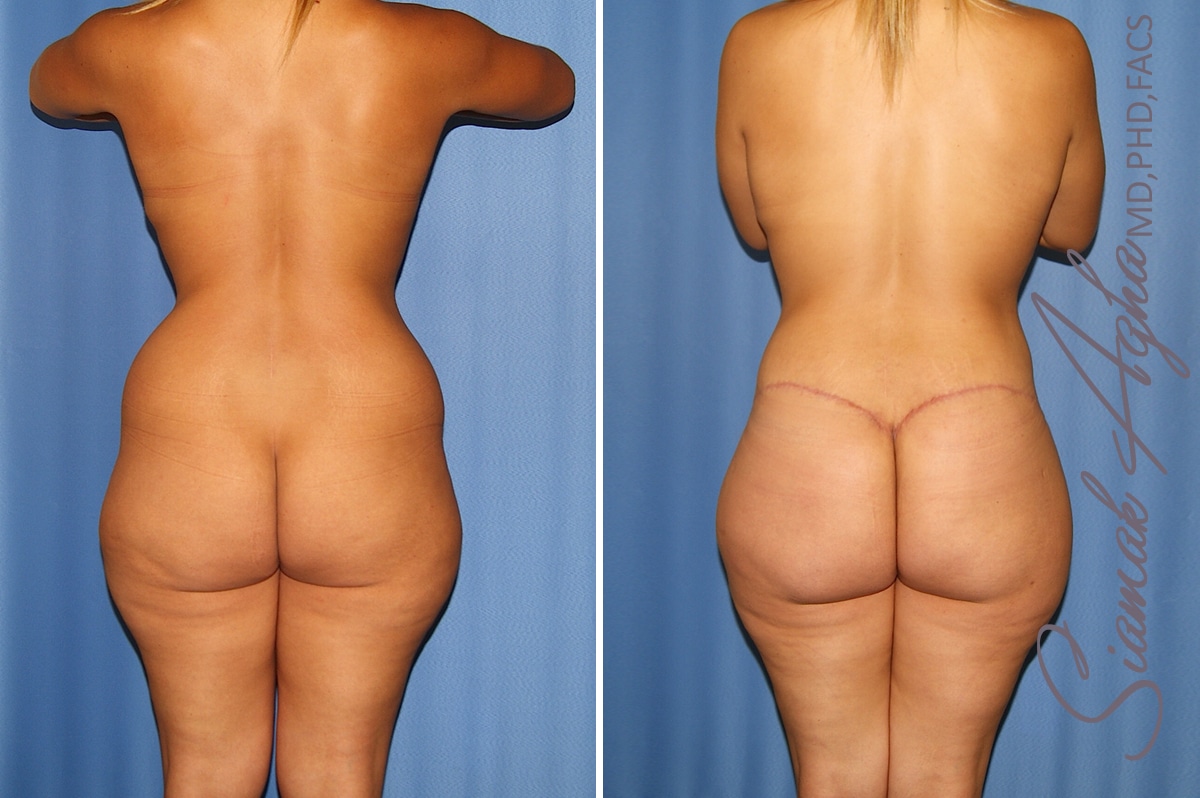 orange county total body lift patient 36 back Newport Beach, CA