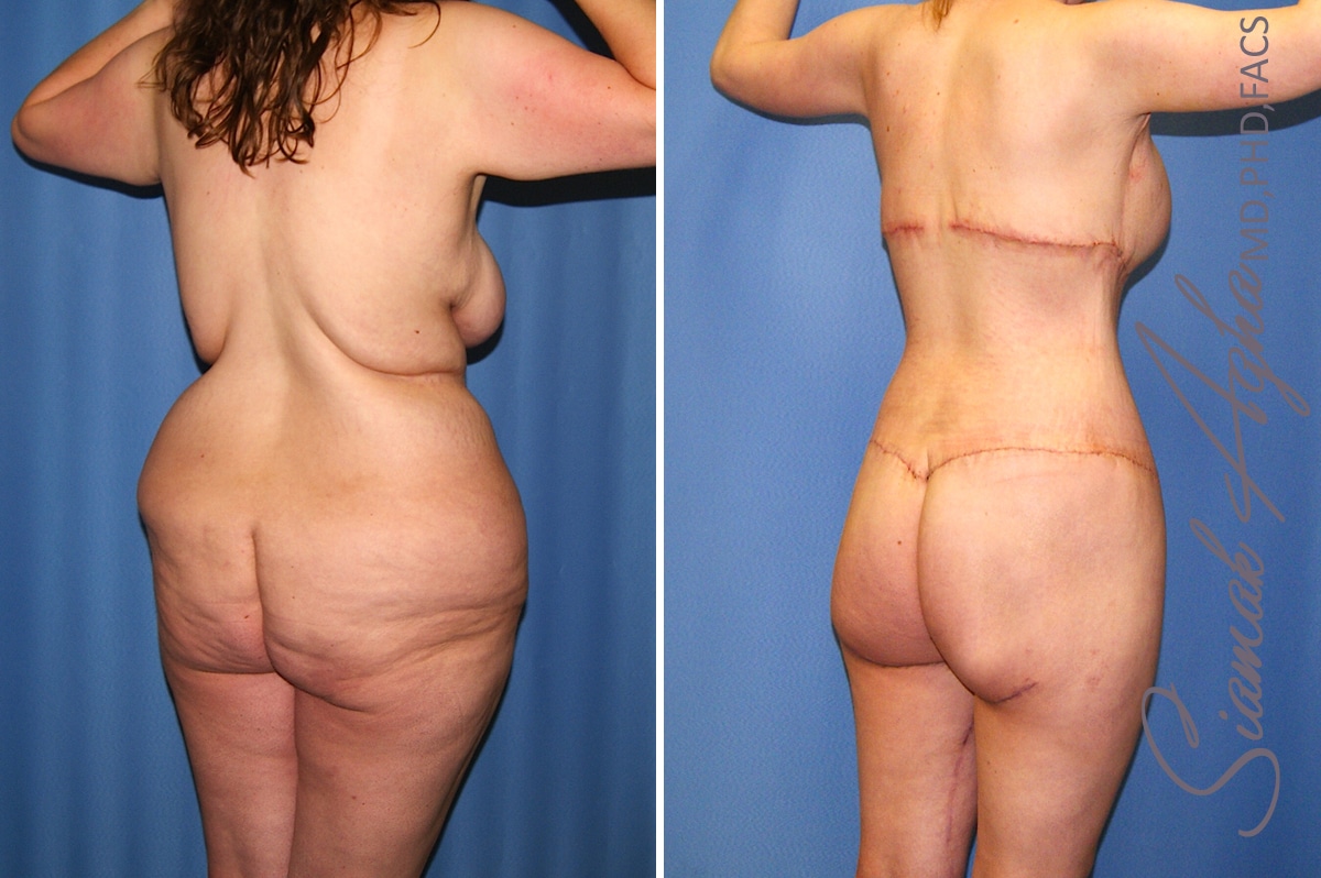 Orange County Total Body Lift Patient 38 Back Right Newport Beach, CA