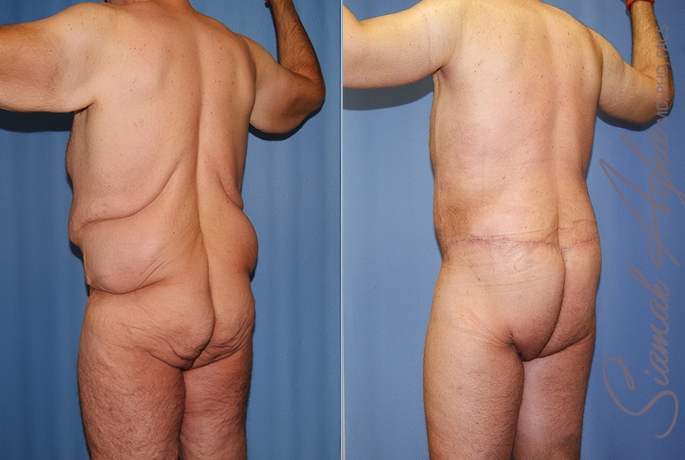 Orange County Total Body Lift Patient 41 Back Left Newport Beach, CA