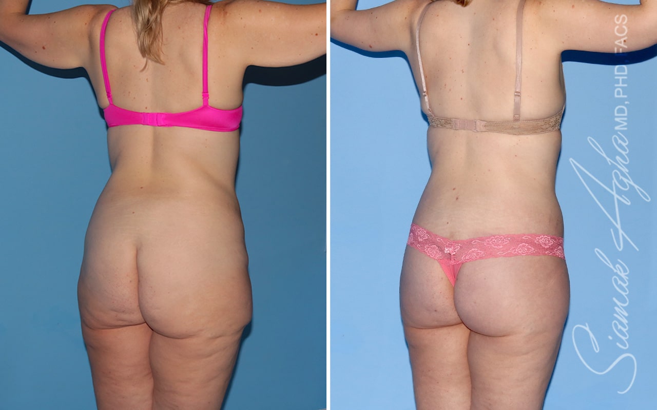 Orange County Total Body Lift Patient 62 Back Right Newport Beach, CA