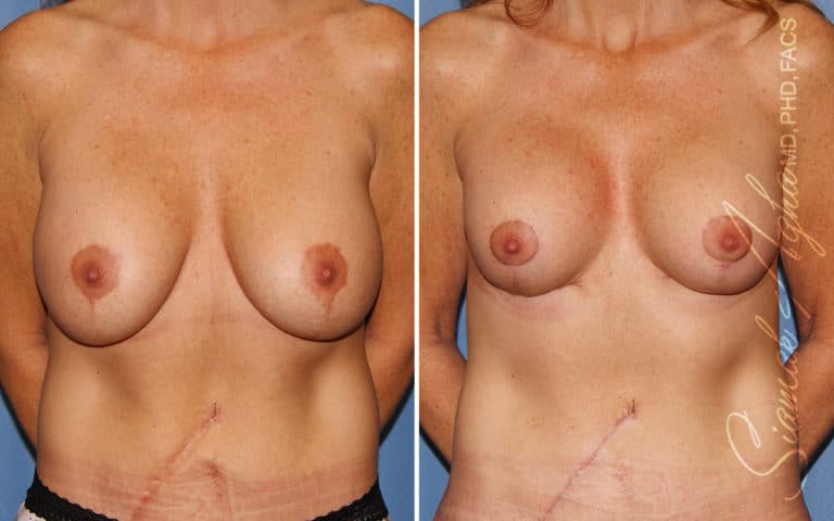 Breast Lift with Augmentation