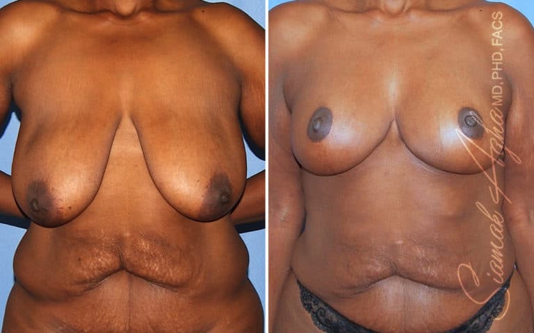 Breast Lift