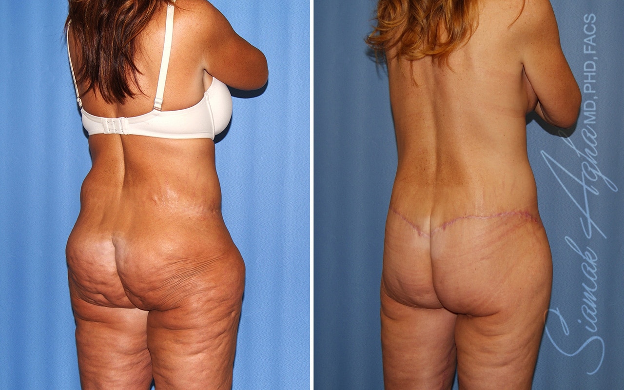 orange county total body lift patient 44 back right Newport Beach, CA