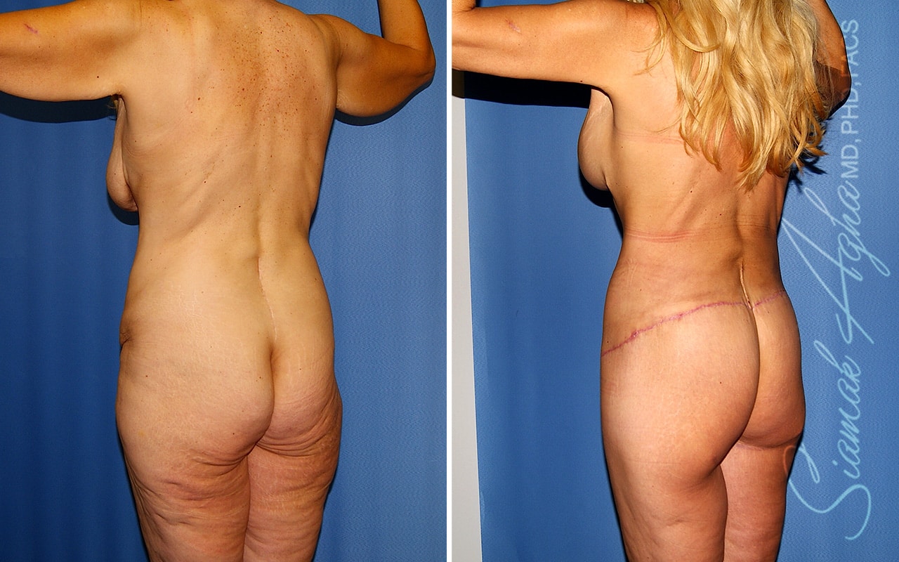 orange county total body lift patient 48 back left Newport Beach, CA