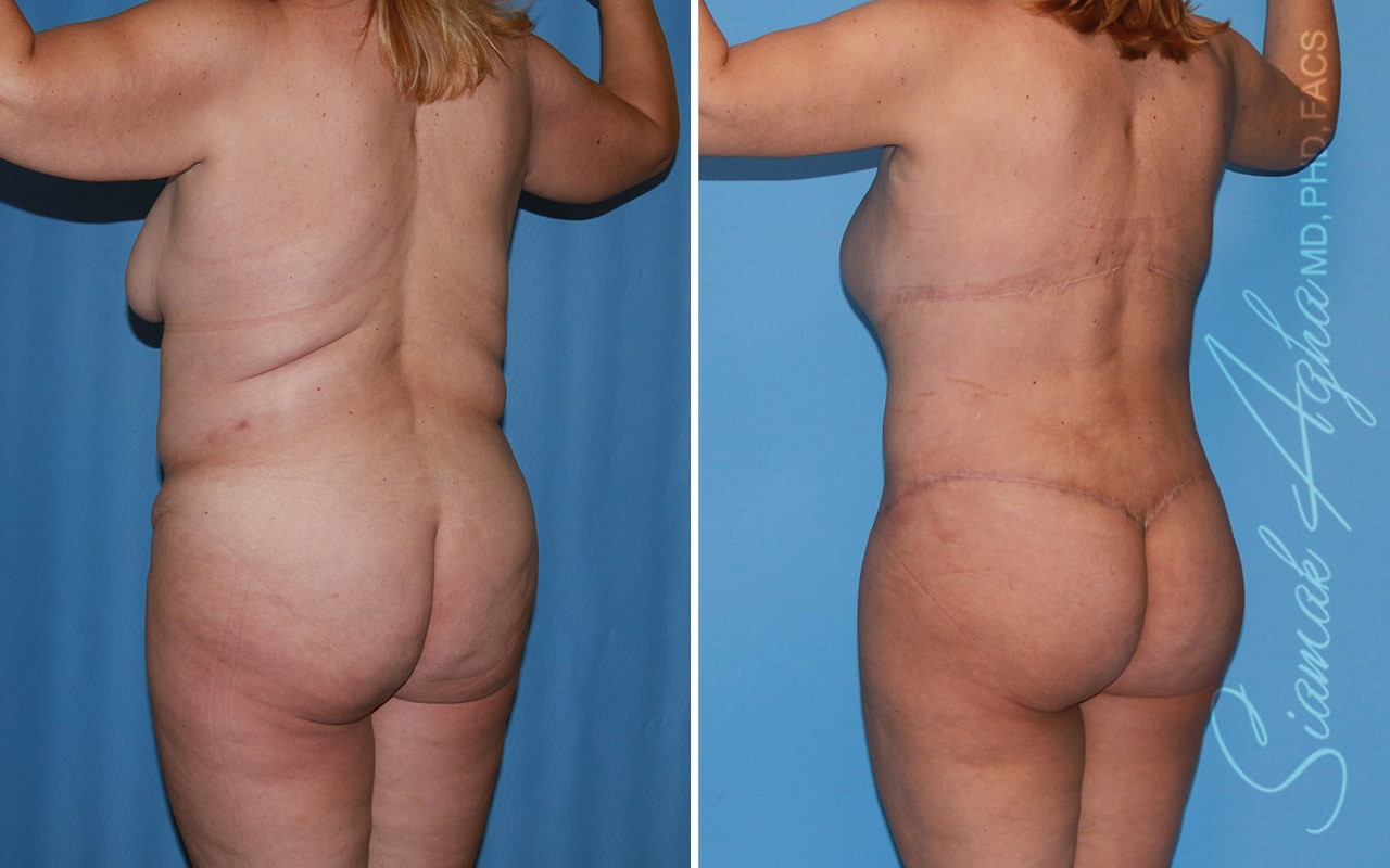 orange county total body lift patient 53 back left Newport Beach, CA