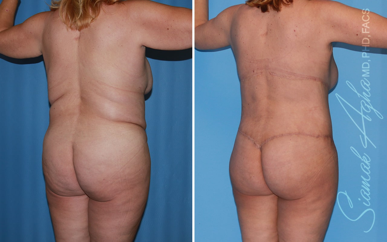 orange county total body lift patient 53 back right Newport Beach, CA