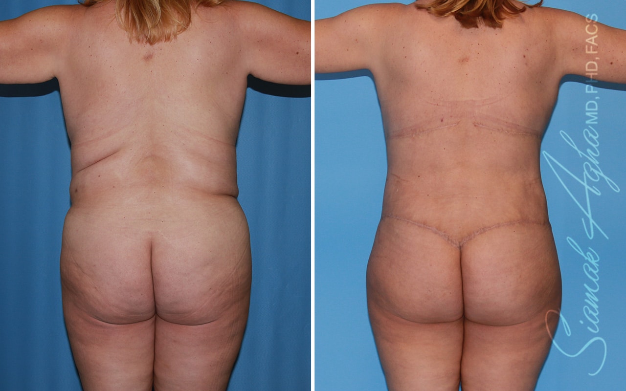 orange county total body lift patient 53 back Newport Beach, CA