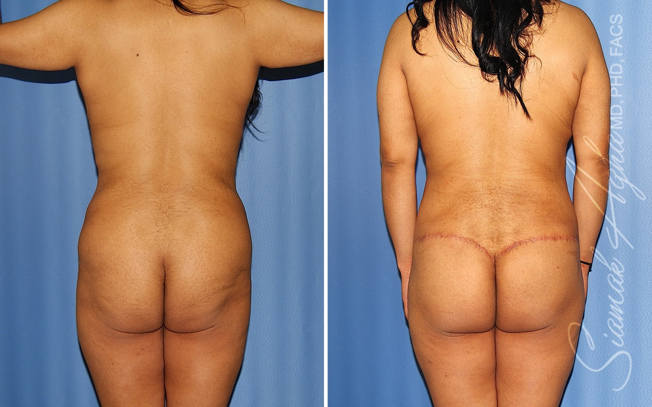 orange county total body lift patient 54 back Newport Beach, CA