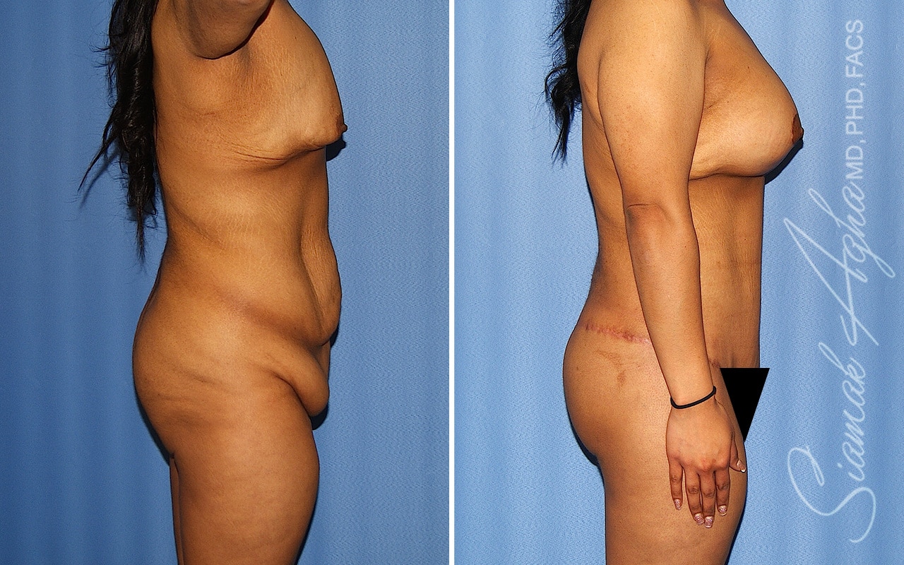 orange county total body lift patient 54 right Newport Beach, CA